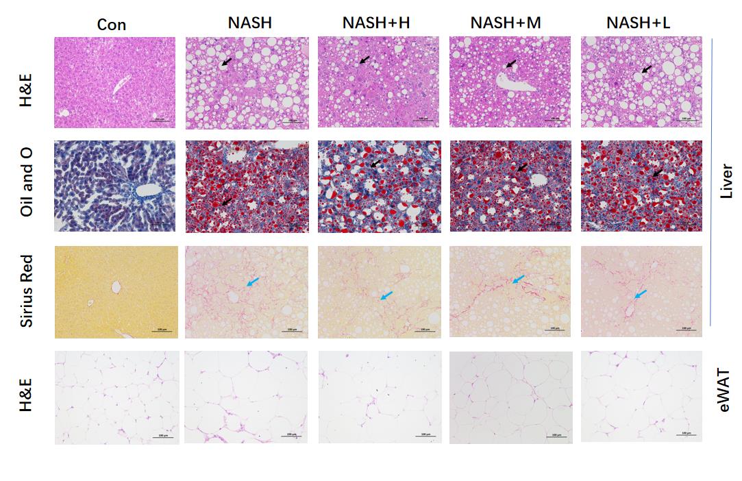 非酒精性肝病(Nonalcoholic Liver Disease,NALD)